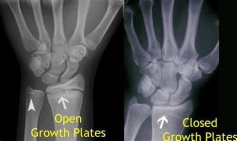 For girls, this usually is when they&39;re 1315; for boys, it&39;s when they&39;re 1517. . How to check if my growth plates are closed at home without x ray